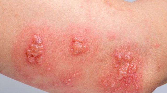 Rộp da là gì? Triệu chứng, nguyên nhân, cách điều trị và phòng ngừa