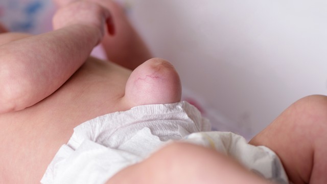 Thoát vị rốn là gì? Những điều cần biết về thoát vị rốn