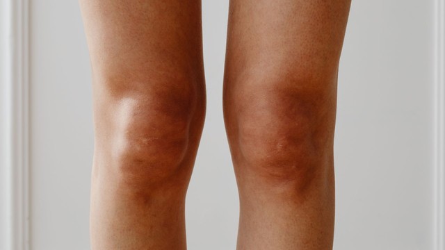 Tràn dịch khớp gối là gì? Những vấn đề cần biết về tràn dịch khớp gối