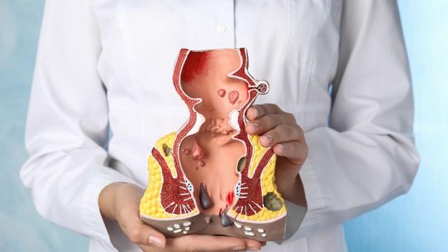 Trĩ nội độ 3 là gì? Những điều cần biết về trĩ nội độ 3