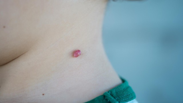 U máu là gì? Triệu chứng, nguyên nhân, cách chẩn đoán và điều trị