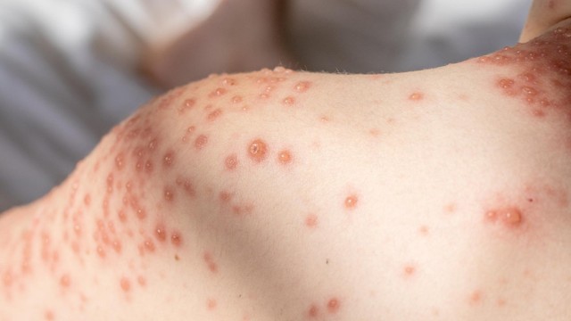 U mềm lây là gì? Triệu chứng, nguyên nhân, cách điều trị và phòng ngừa