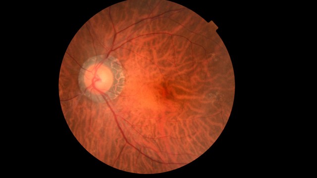 U nguyên bào võng mạc là gì? Những điều cần biết về u nguyên bào võng mạc