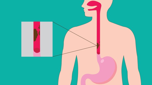 Ung thư thực quản là gì? Nguyên nhân, triệu chứng và cách điều trị