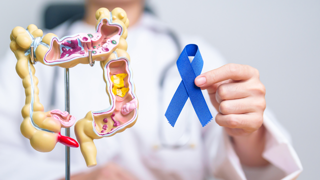 Ung thư trực tràng giai đoạn 2​ là gì? Nguyên nhân, triệu chứng và cách điều trị