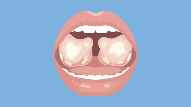 Viêm amidan hốc mủ: Nguyên nhân, phương pháp điều trị và phòng ngừa bệnh