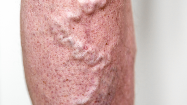 Viêm tĩnh mạch là gì? Dấu hiệu, nguyên nhân, cách điều trị và phòng ngừa