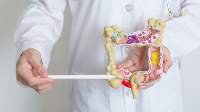 Viêm túi thừa là gì? Triệu chứng, nguyên nhân và cách phòng ngừa hiệu quả