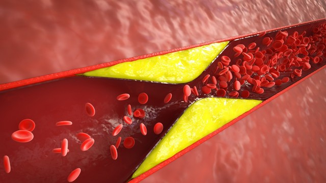 Xơ vữa động mạch là gì? Nguyên nhân và cách phòng ngừa hiệu quả