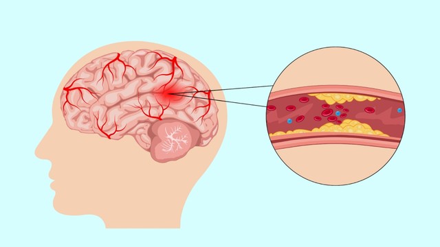 Xơ vữa động mạch cảnh: Dấu hiệu, nguyên nhân, phương pháp chẩn đoán, điều trị và phòng ngừa