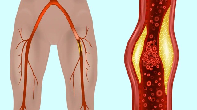 Xơ vữa động mạch chi dưới: Dấu hiệu, nguyên nhân, phương pháp chẩn đoán, điều trị và phòng ngừa