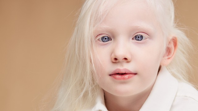 Bệnh bạch tạng có di truyền không và nguy cơ truyền sang con?