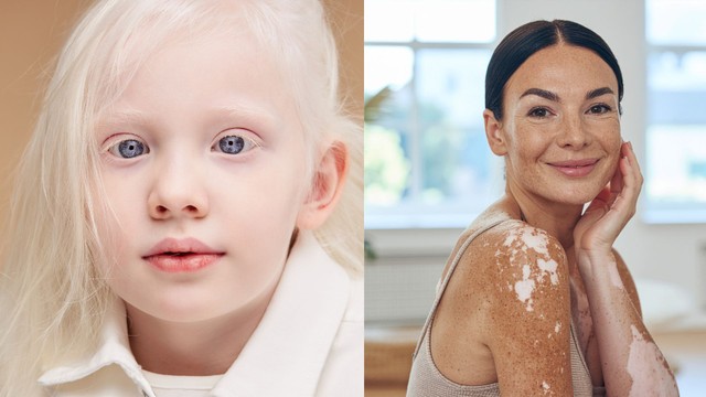 Bệnh bạch tạng và bạch biến: Cách phân biệt chính xác, tránh nhầm lẫn