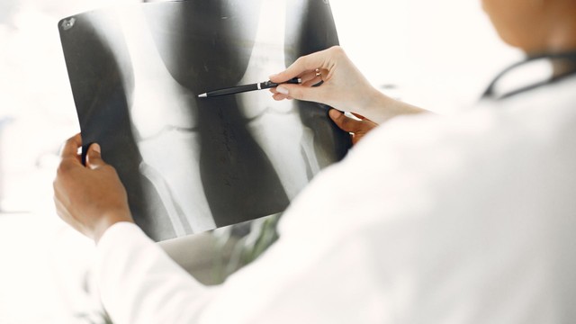 Bệnh còi xương: Triệu chứng, nguy cơ, cách điều trị và phòng ngừa