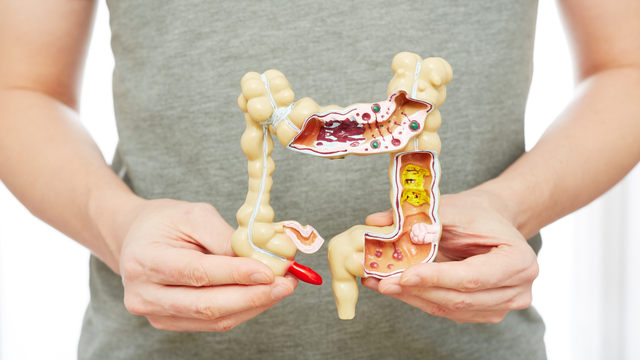 Bệnh Crohn đại tràng: Triệu chứng, phương pháp điều trị và phòng ngừa