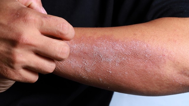 Bệnh da do nấm sợi: Nhận biết sớm, điều trị đúng và phòng tái phát