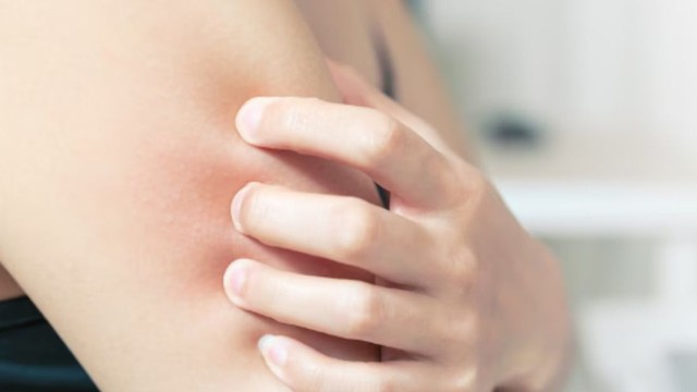 Bệnh hắc lào có lây không​? Những ai có nguy cơ bị hắc lào?