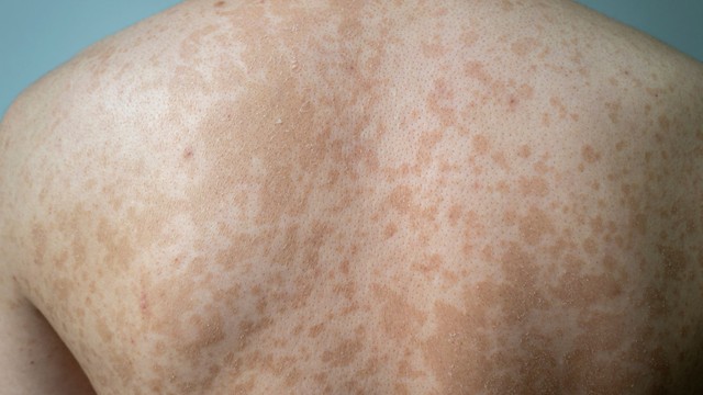 Bệnh lang ben có lây không​? Lang ben lây qua đường nào?
