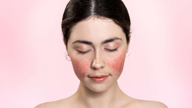 Bệnh lupus ban đỏ có lây không? Cơ chế hình thành bệnh lupus ban đỏ