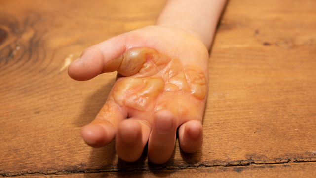 Bệnh pemphigus là gì? Triệu chứng, nguyên nhân và cách điều trị