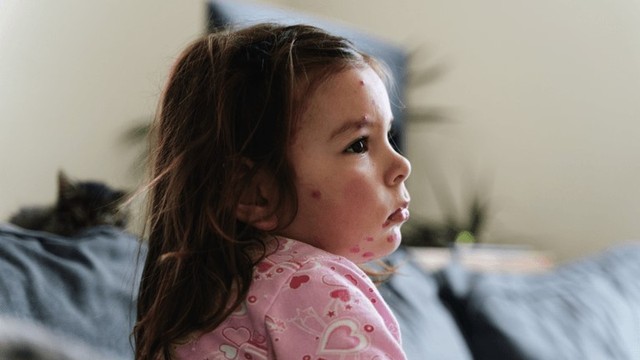 Bệnh Rubella và những thông tin cần biết