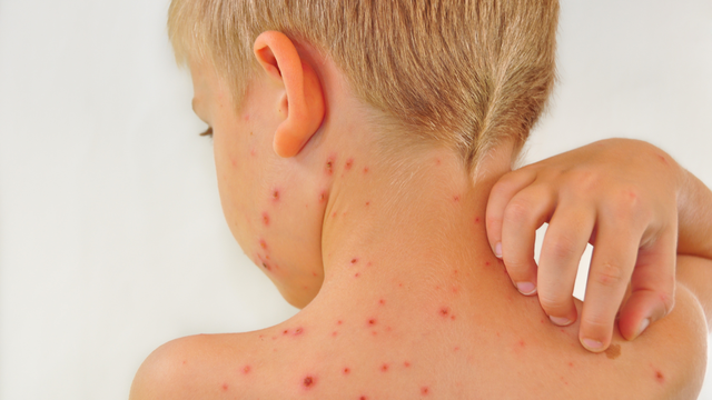 Bệnh sởi có ngứa không? Tìm hiểu triệu chứng và cách giảm ngứa