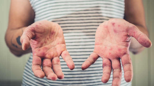 Bệnh sởi ở người lớn có nguy hiểm không? Những điều không nên chủ quan