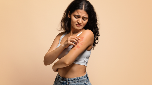 Bệnh vẩy nến nhẹ là gì? Dấu hiệu nhận biết và cách kiểm soát bệnh