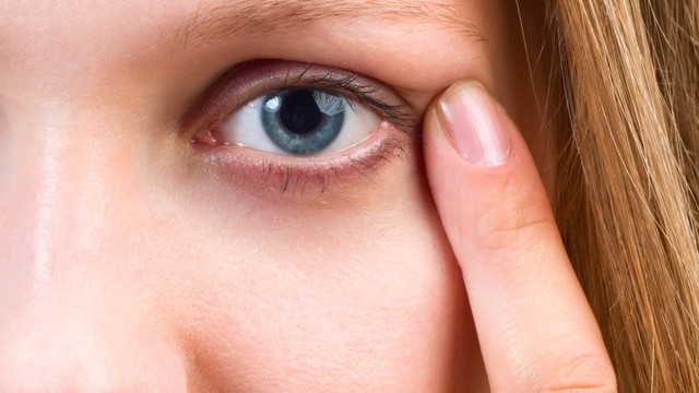 Bệnh viêm bờ mi mắt có nguy hiểm không? Cách phòng ngừa hiệu quả