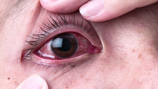 Bệnh viêm giác mạc bao lâu khỏi? Dấu hiệu hồi phục bạn nên biết