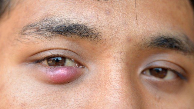 Bị chắp mắt có nên mổ không? Khi nào cần mổ?