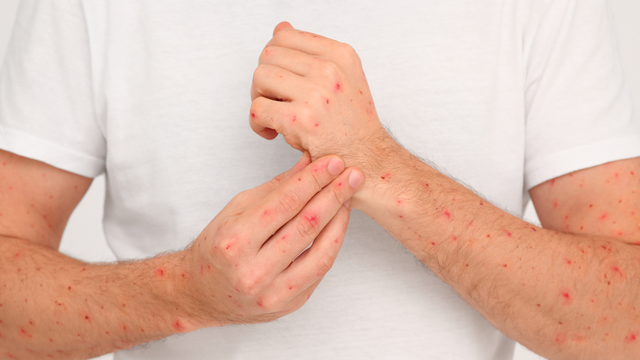 Bị đậu mùa khỉ kiêng gì? Hướng dẫn chăm sóc và phòng ngừa hiệu quả