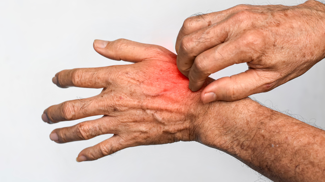 Người bị ghẻ nước có tự khỏi không? Khi nào cần đi khám bác sĩ?