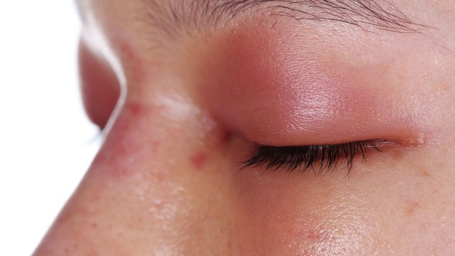 Bị kiến cắn sưng mí mắt phải làm sao để nhanh hết sưng?