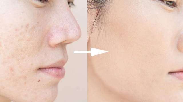 Bị mụn nhọt kiêng ăn gì? Top 9 thực phẩm nên tránh để da nhanh lành