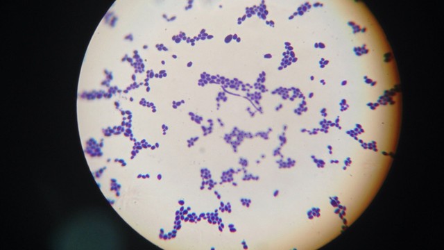 Bị nấm Candida có ảnh hưởng đến kinh nguyệt không? Khi nào cần đi khám phụ khoa?