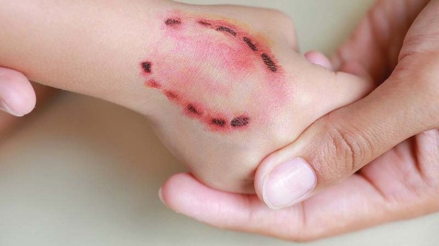 Bị người cắn có sao không? Khi nào cần đi khám ngay?