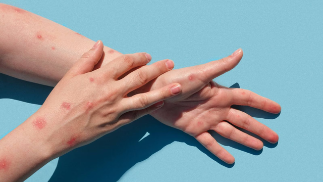 Bị thủy đậu ngứa không ngủ được phải làm sao để dễ chịu hơn?