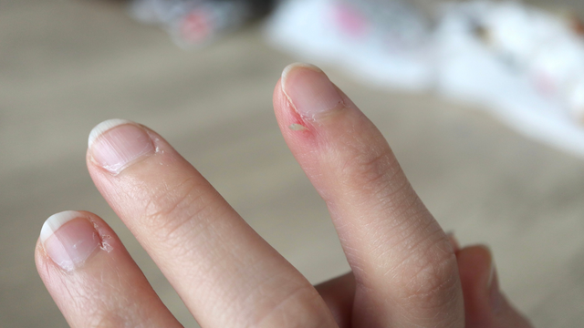 Bị xước măng rô là thiếu chất gì? Làm thế nào để hạn chế tình trạng này?