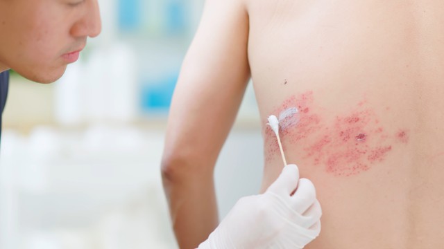 Bị zona thần kinh bôi gì? Cách lựa chọn thuốc bôi zona thần kinh theo từng trường hợp