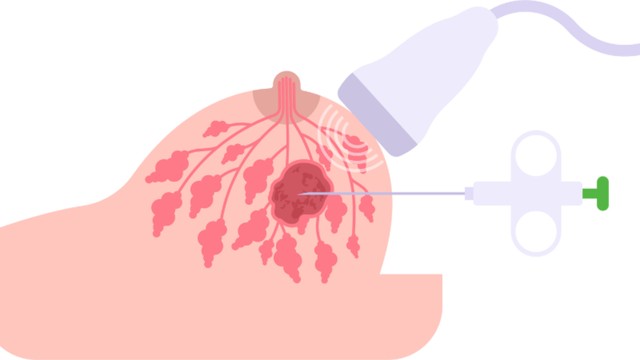 BIRADS 3 có cần sinh thiết không? Giải đáp chi tiết cho người bệnh