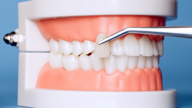 Bọc răng sứ có bị hôi miệng không và cách khắc phục