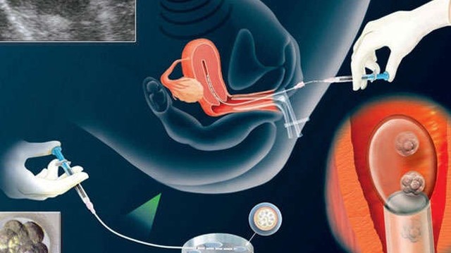 Bơm IUI sau 7 ngày có gì khác không? Dấu hiệu thụ thai