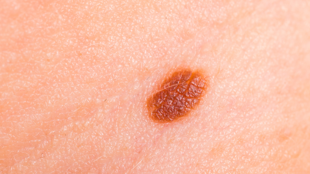 Bớt sùi thượng bì: Khi nào cần đi khám bác sĩ da liễu?