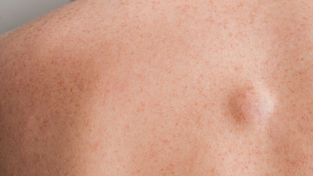 Bướu mỡ có nguy hiểm không? Nguyên nhân, dấu hiệu và hướng điều trị