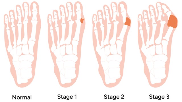 Các giai đoạn của bệnh gout và dấu hiệu nhận biết sớm gout