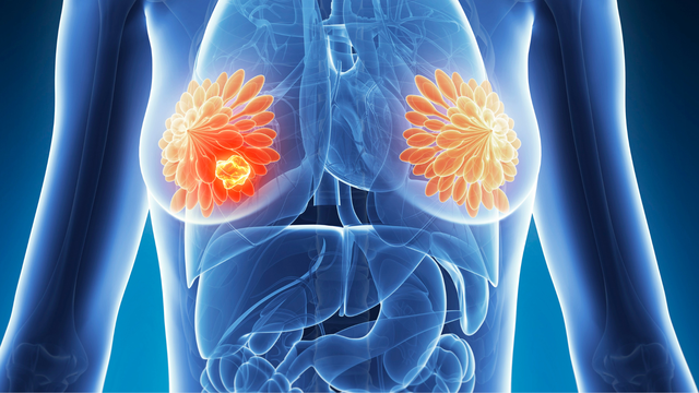 Các loại khối u ở vú cần chú ý và dấu hiệu cần đi khám