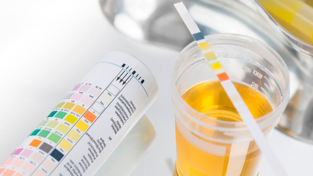 Các xét nghiệm tổng phân tích nước tiểu có ý nghĩa như thế nào?