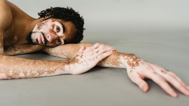 Cách chữa bệnh bạch biến hiệu quả và an toàn