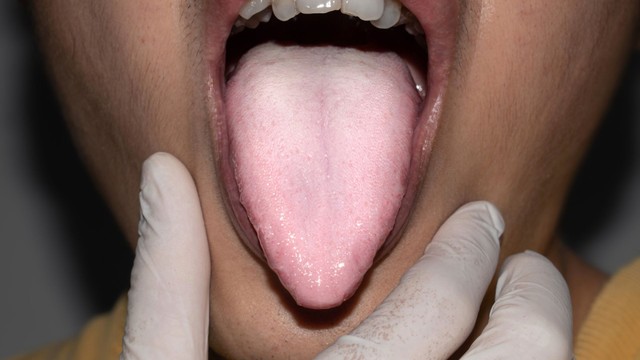 Cách chữa lưỡi bị mất vị giác hiệu quả và an toàn ngay tại nhà